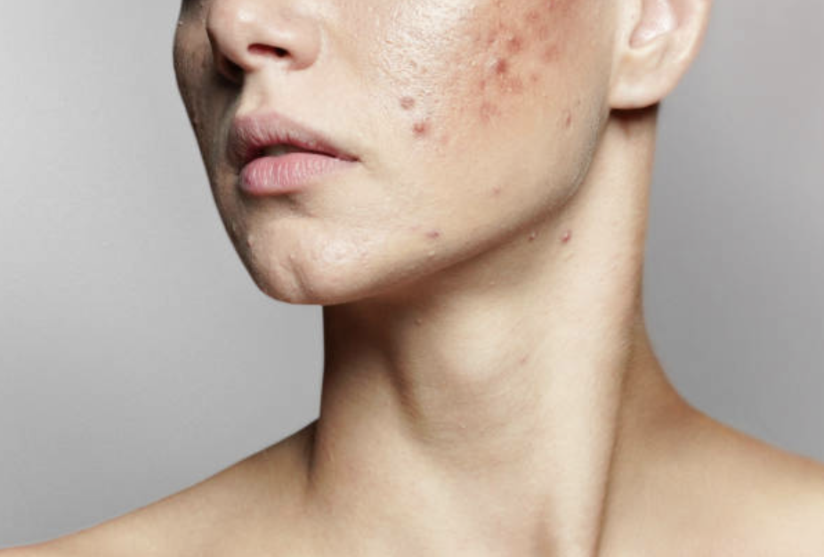 Fighting against acne: the iO Clinic doctors scientific approach 